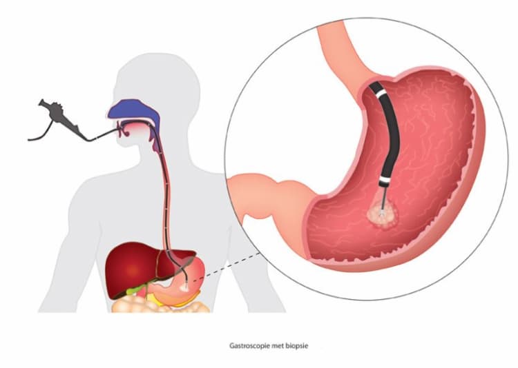 La gastroscopie ou endoscopie digestive haute est un examen médical qui permet au médecin de détecter plus clairement des lésions et de procéder à des biopsies